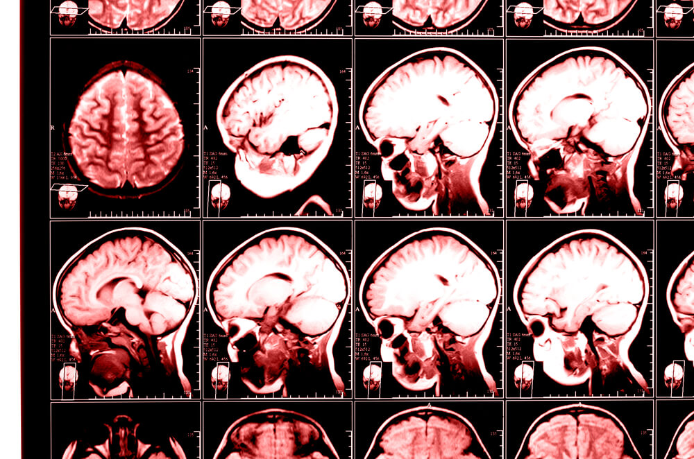 Brain injury scans
